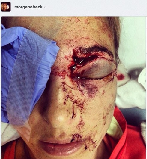 Mới đây, Morgan Beck đã đăng tải một hình ảnh trên trang Twitter khiến người hâm mộ bàng hoàng khi mắt trái của cô bị bầm dập và dính đầy máu.
